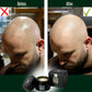 Balding cream